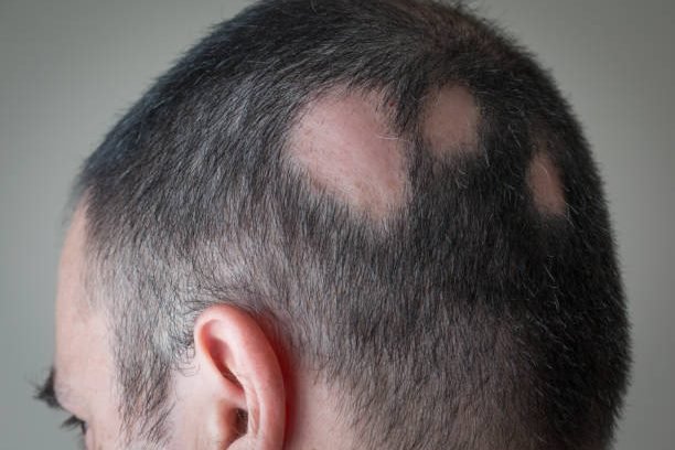 Alopecia areata
