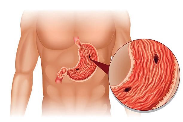 Stomach Ulcer in human body illustration