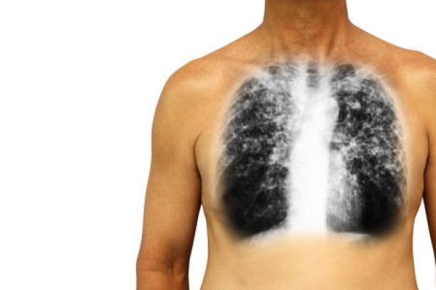 Pulmonary tuberculosis . Human chest with x-ray show interstitial infiltrate both lung due to infection . Isolated background . Blank area at Left side .