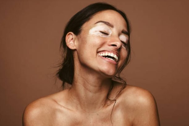 Portrait of a smiling young woman with vitiligo. Close up of woman with skin disorder smiling with eyes closed against brown background.